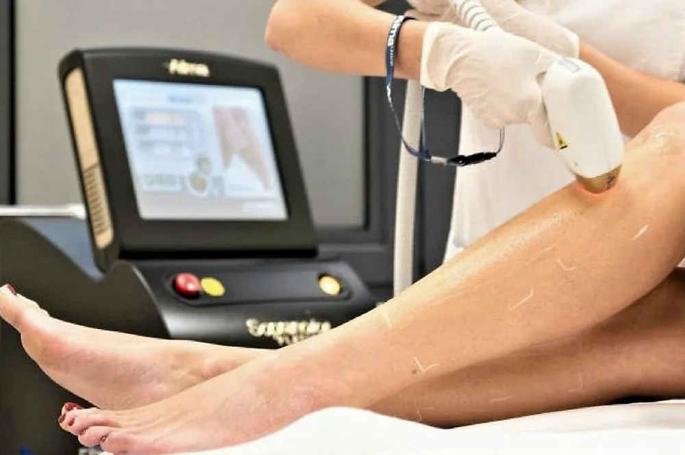 Depilação a laser — como o laser destrói o folículo piloso
