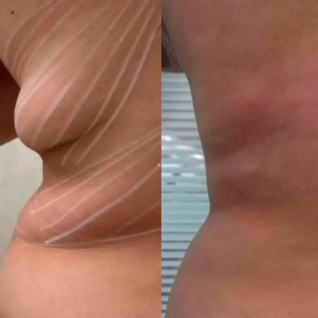 Endolaser Five Techniques — critérios de escolha entre Endolift e HIFU