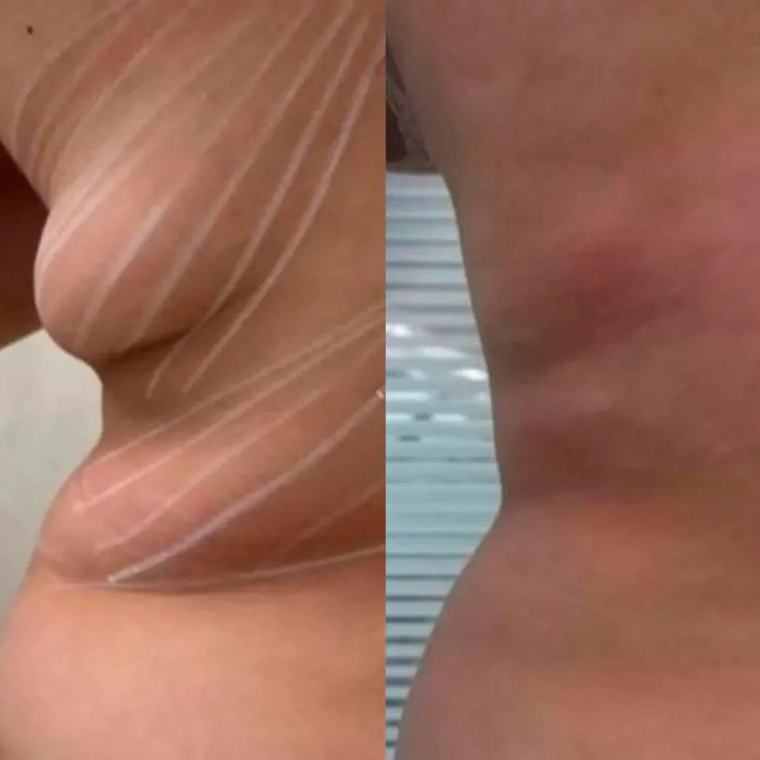 Endolaser Five Techniques — critérios de escolha entre Endolift e HIFU
