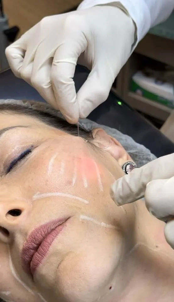 Endolaser no jowl e no terço inferior — retração e definição da linha da mandíbula