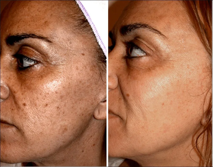 Etherea MX Completo — laser toning de baixa fluência no melasma