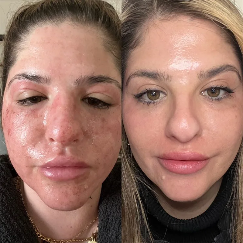 O Melhor Curso de CO₂ do Mundo — CO₂ fracionado no rejuvenescimento facial