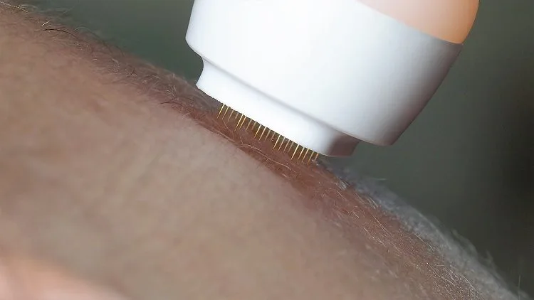 Secret DUO — profundidade de agulha por subtipo de cicatriz de acne
