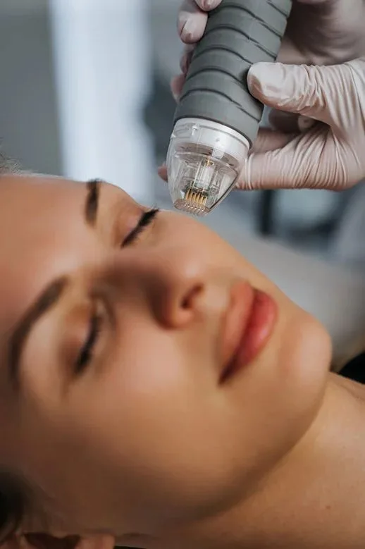 Secret DUO — aplicação de RF microagulhada em cicatriz de acne