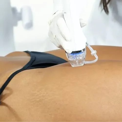 Secret DUO — controle robótico de profundidade das microagulhas