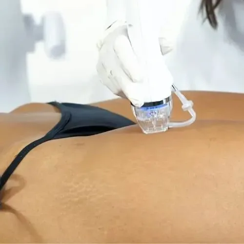 Secret DUO — controle robótico de profundidade das microagulhas