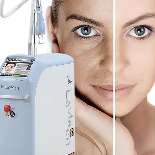 Curso Lavieen — precisão do Túlio 1927 nm frente à IPL no melasma