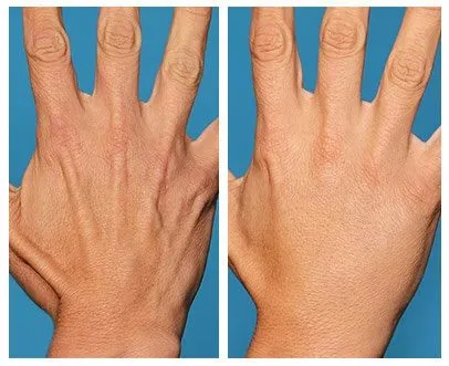 Curso Lavieen — tratamento homogêneo do campo de cancerização