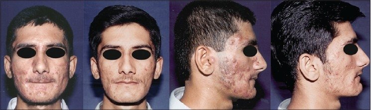 acne inflamatória antes depois IPL luz pulsada porfibrina bacteriana tratamento