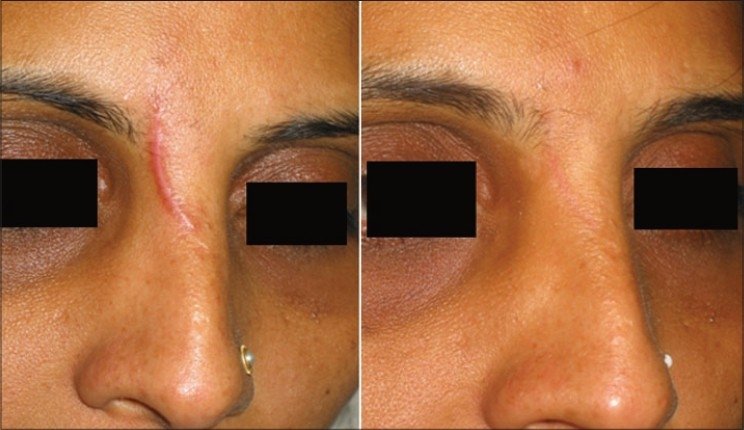 cicatriz hipertrófica antes depois tratamento combinado PDL IPL sinergia