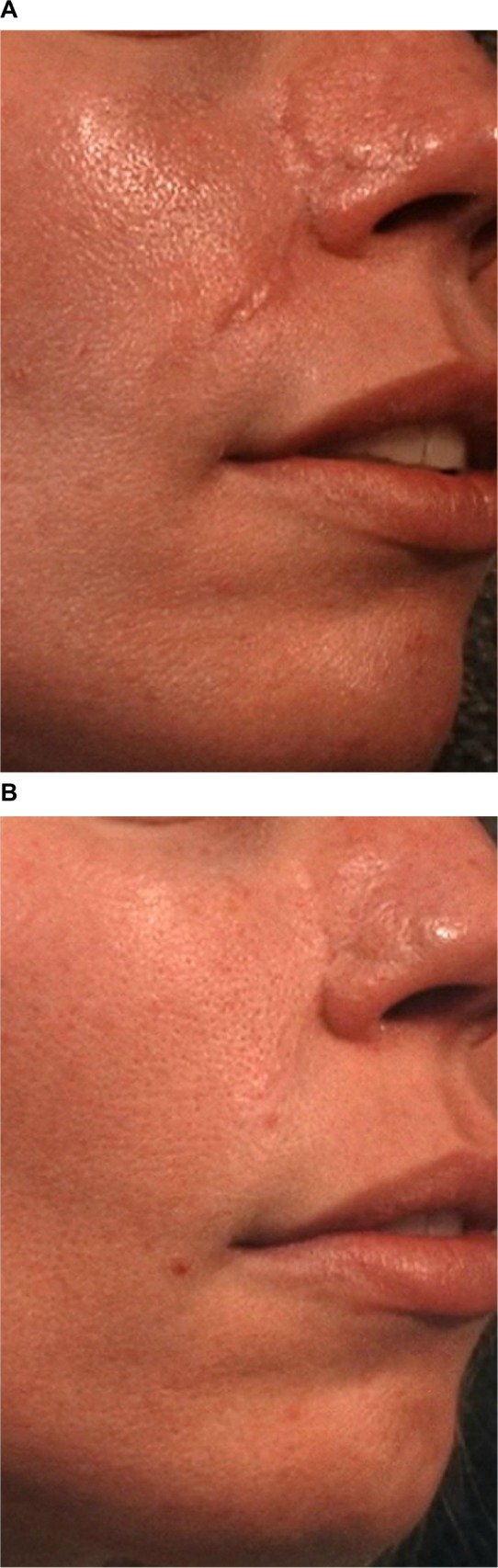 cicatriz hipertrófica eritematosa antes depois laser PDL tratamento dermatológico resultado clínico