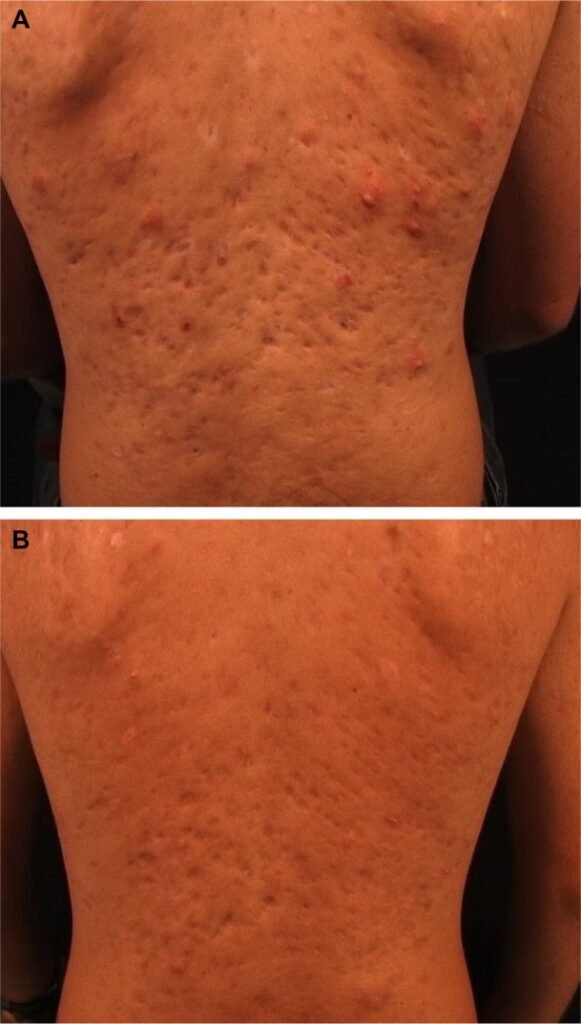 cicatrizes atróficas de acne boxcar rolling antes depois laser CO2 fracionado 10600nm resurfacing