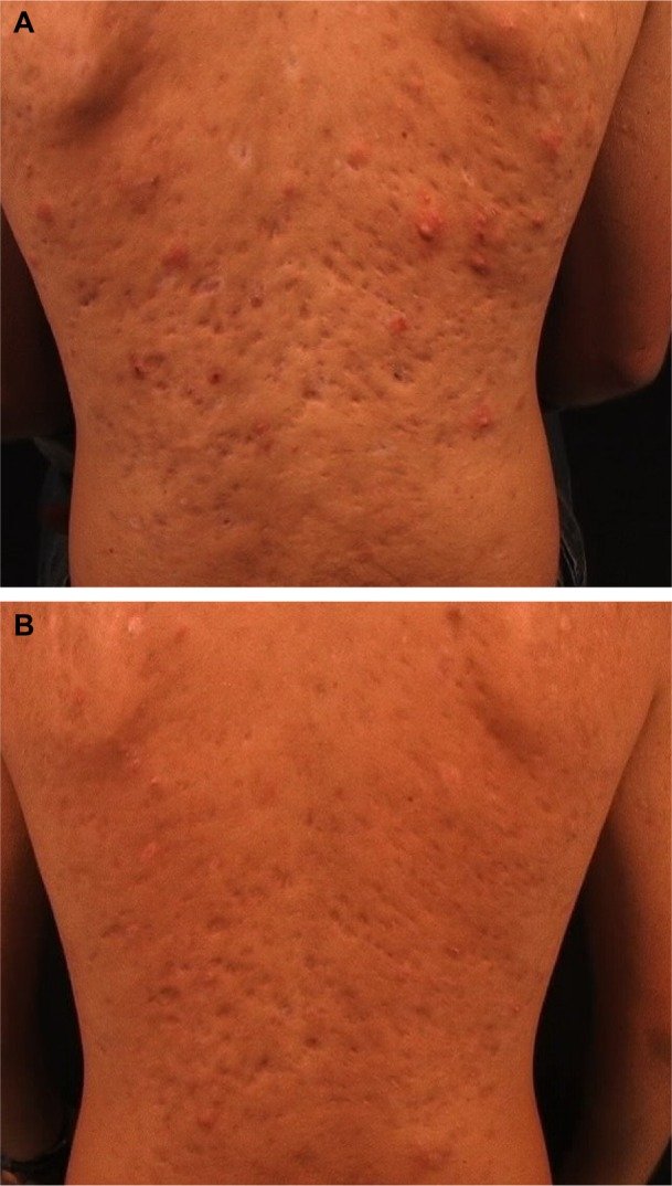 cicatrizes atróficas acne CO2 10600nm ablativo comparação Erbium YAG