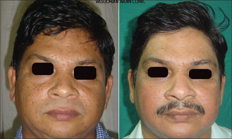 cicatrizes varicela pele antes depois CO2 ablativo resultado clínico