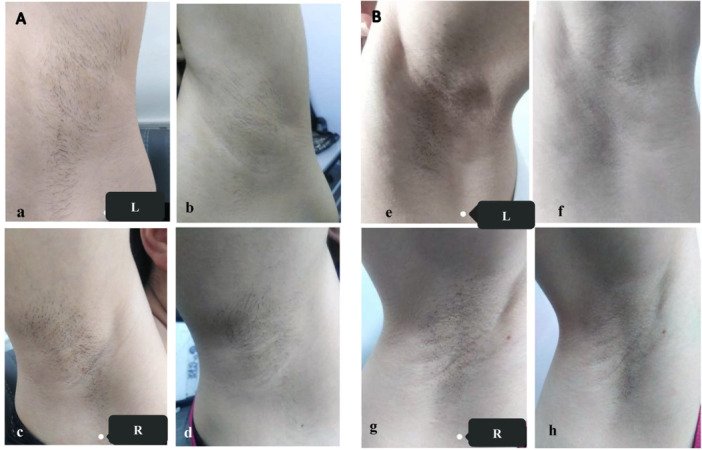 depilação a laser alexandrite 755nm resultado clínico axila antes depois fotodepilação
