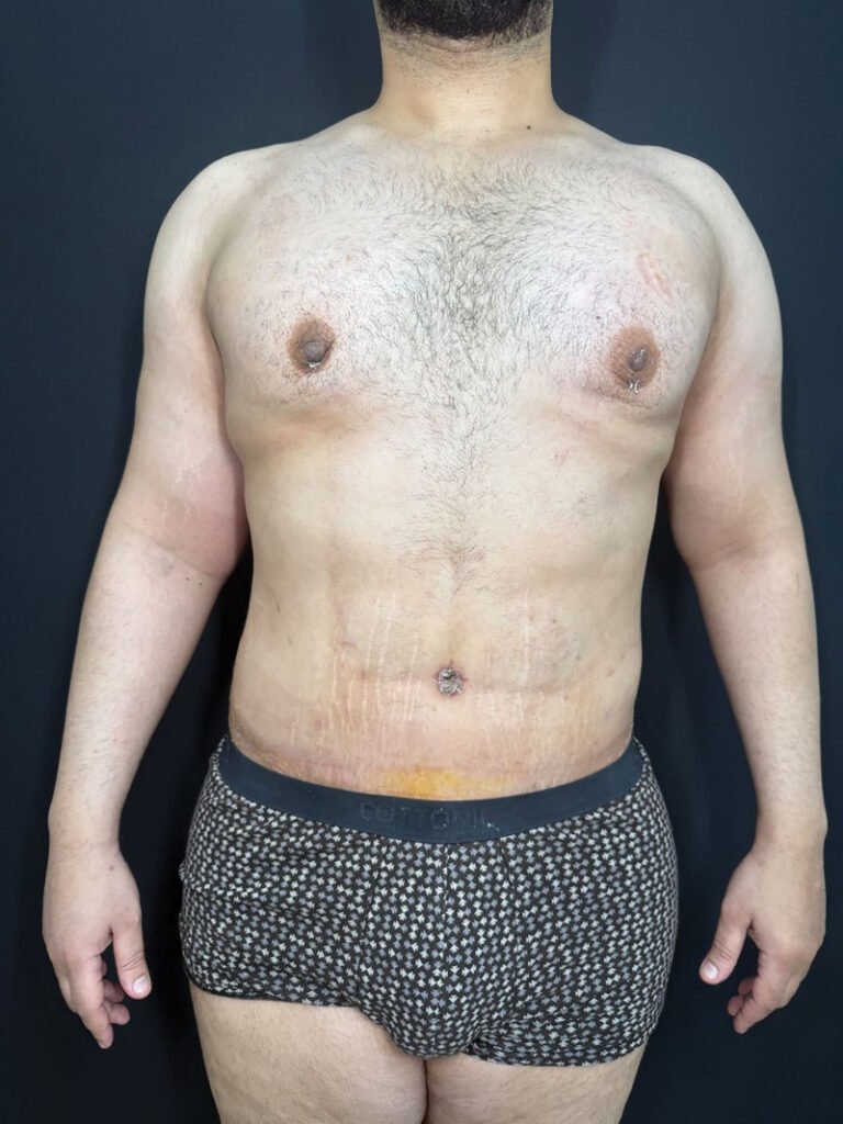 endolaser 1470nm laser lipólise corporal remodelamento contorno resultado clínico