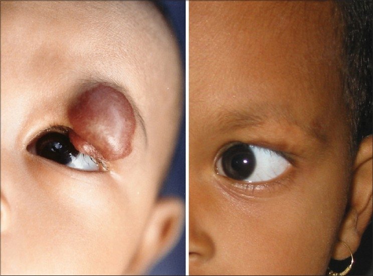 hemangioma Nd:YAG 1064nm segurança fototipo alto vascular pele escura