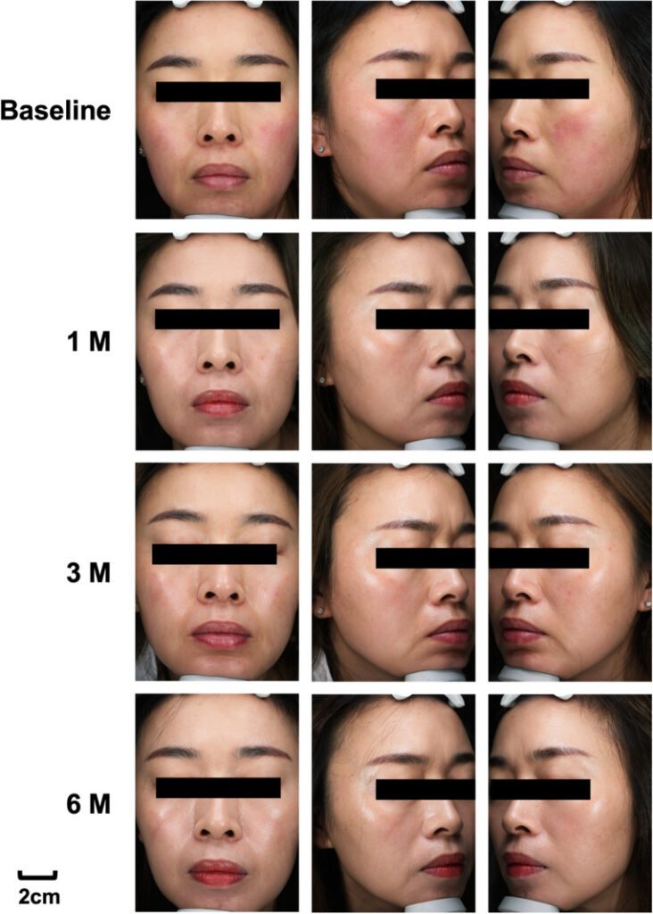 HIFU micro-focused ultrasound lifting facial inferior terço antes depois