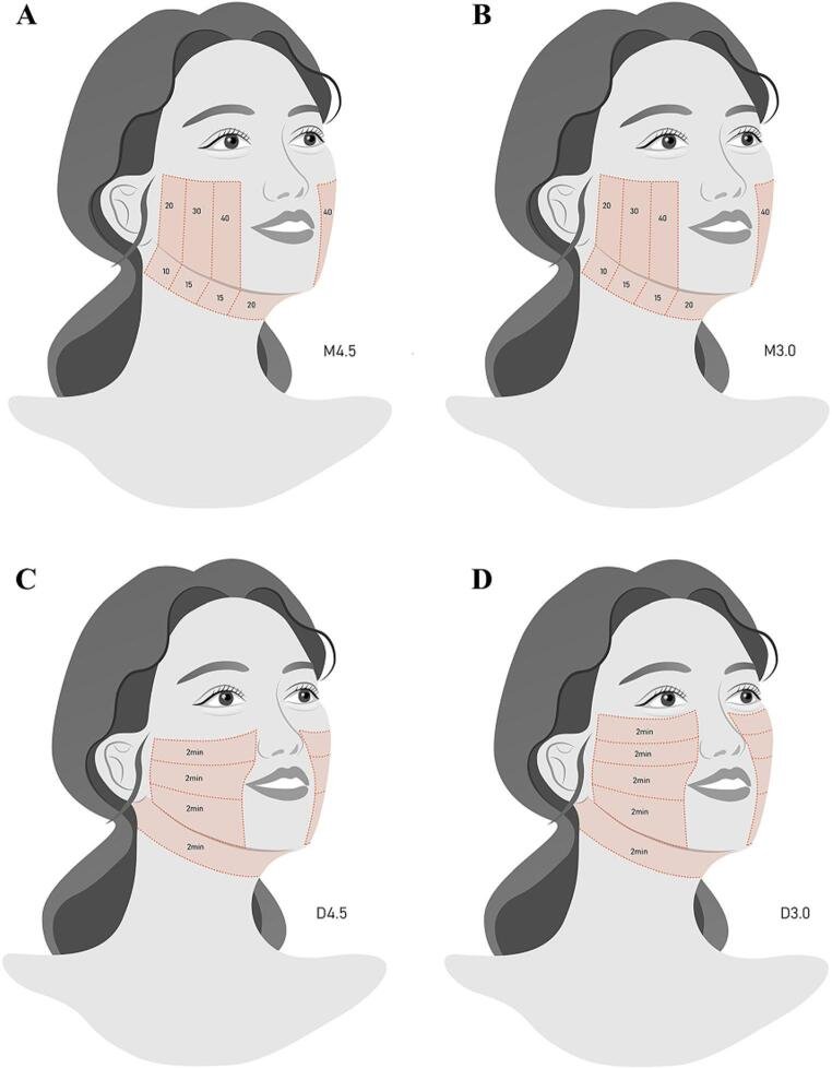 HIFU ultrassom microfocalizado rejuvenescimento facial antes depois lifting sem cirurgia