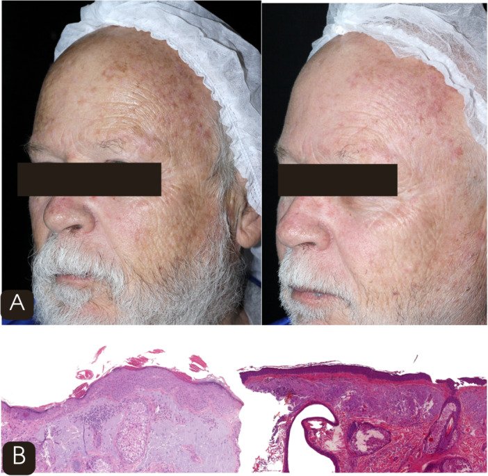 laser 1927nm thulium fracionado textura pele antes depois BB laser Lavieen queratose actínica rejuvenescimento