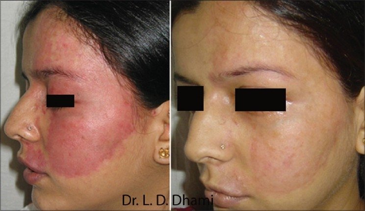 mancha vinho porto antes depois PDL 595nm tratamento vascular laser dermatologia resultado clínico