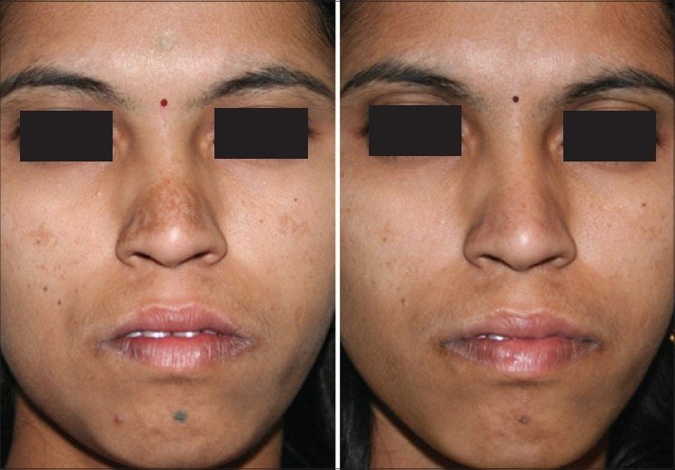 melasma facial antes depois IPL luz pulsada intensa filtro 645nm