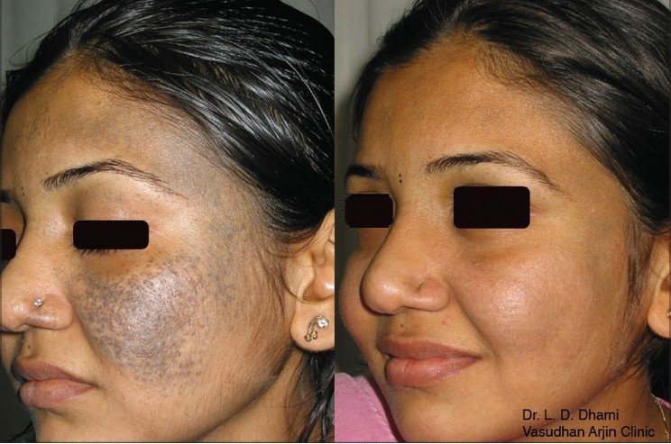 nevo de Ota hiperpigmentação periorbital antes depois Q-switched Nd:YAG 1064nm