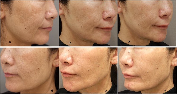 radiofrequência microagulhada Potenza resultado clínico pele antes depois cicatrizes tratamento dermatologia