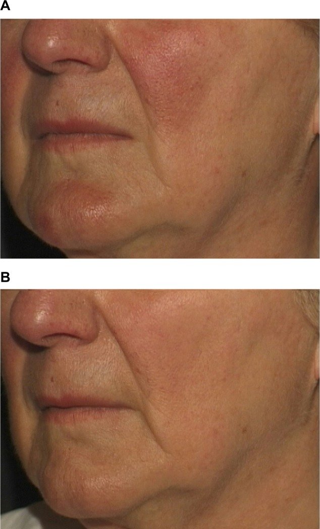 rosacea telangiectasias Nd:YAG 1064nm antes depois pele pigmentada fototipo