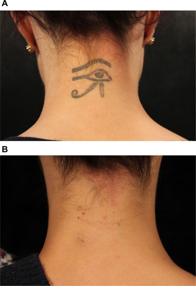 tatuagem profissional antes depois remoção Nd:YAG Q-switched picossegundo laser