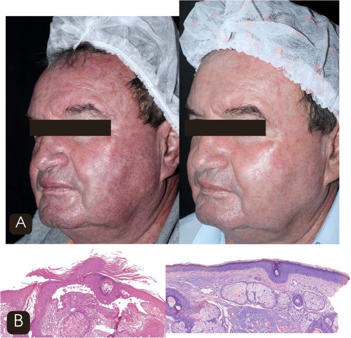 laser thulium 1927nm fracionado campo cancerização resultado clínico antes depois queratose actínica tratamento